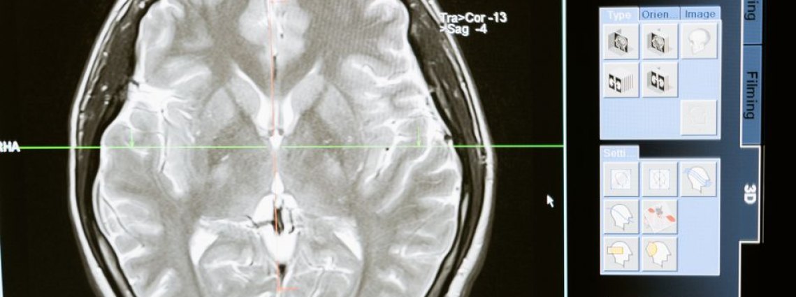 Estudo de imagem cerebral mostrando os efeitos da cetamina.